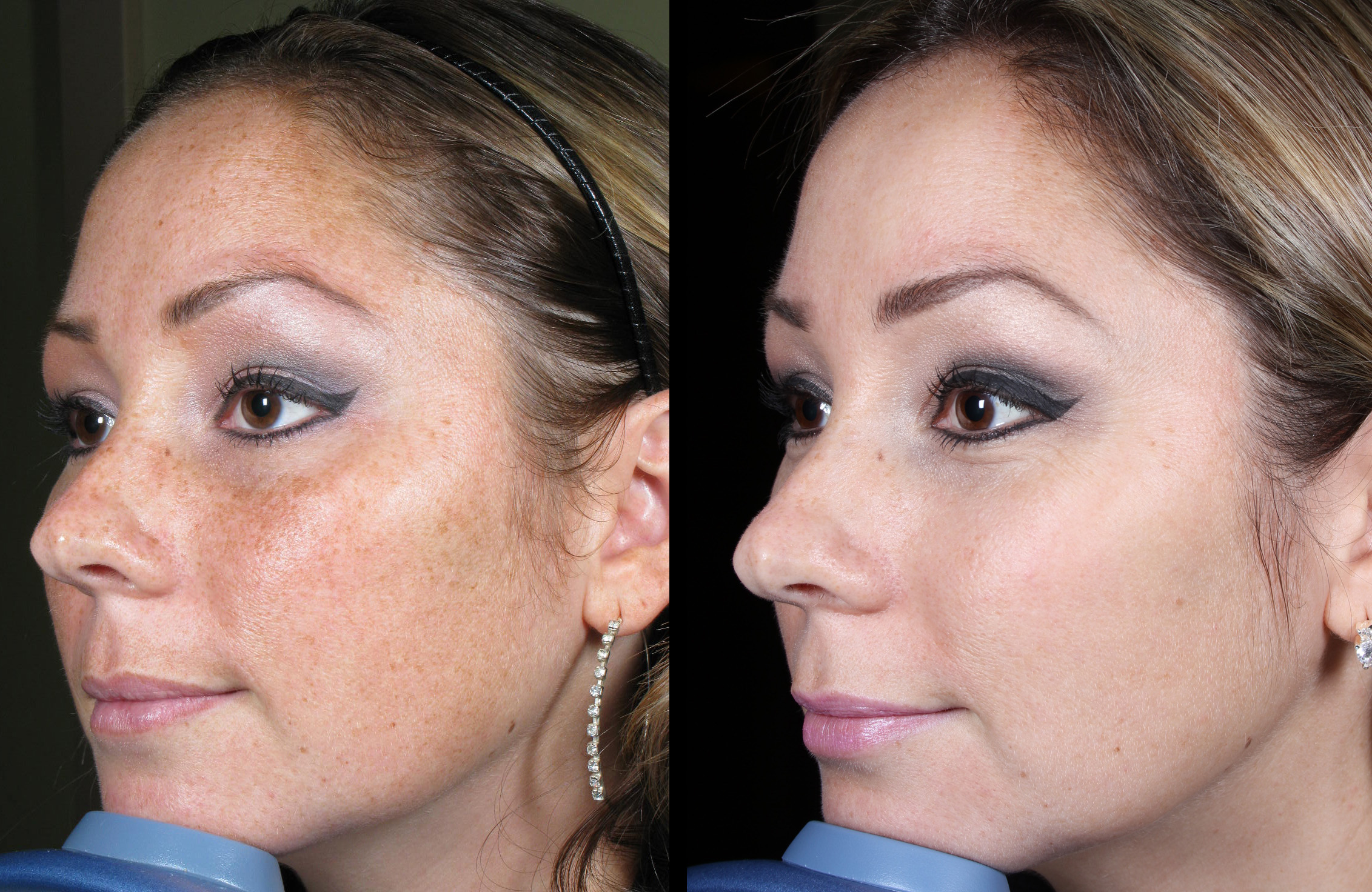 Laser Brown Spots Md Esthetics