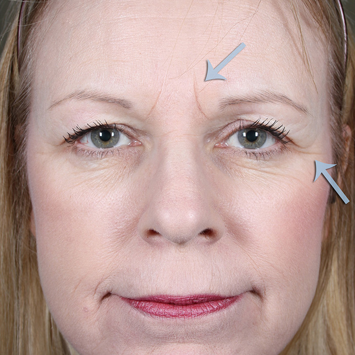 MD-Esthetics-Botox-07-Before - MD ESTHETICS