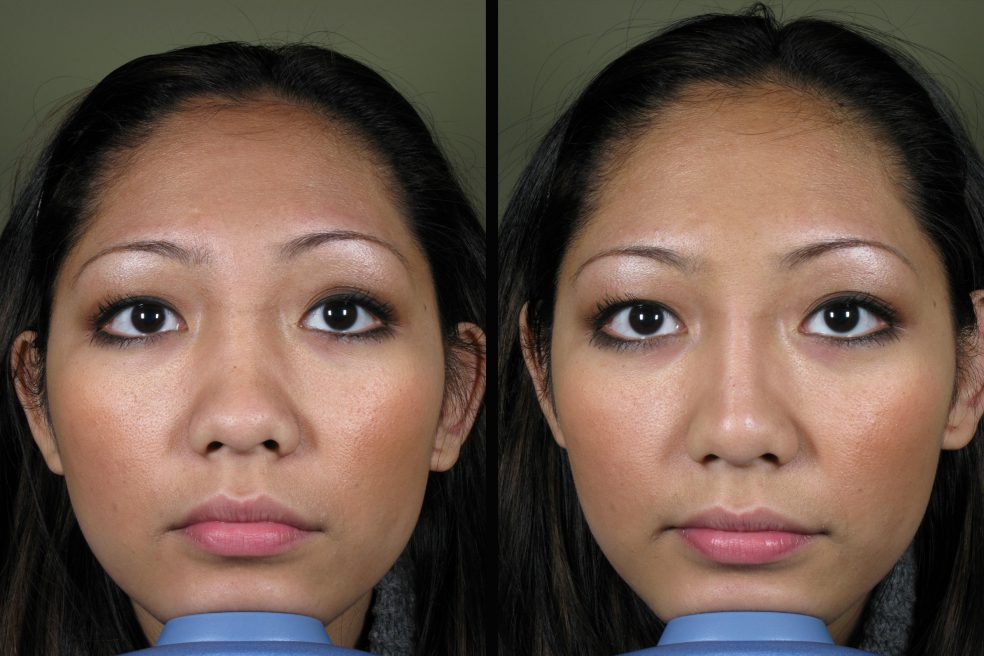 nose contour with fillers
