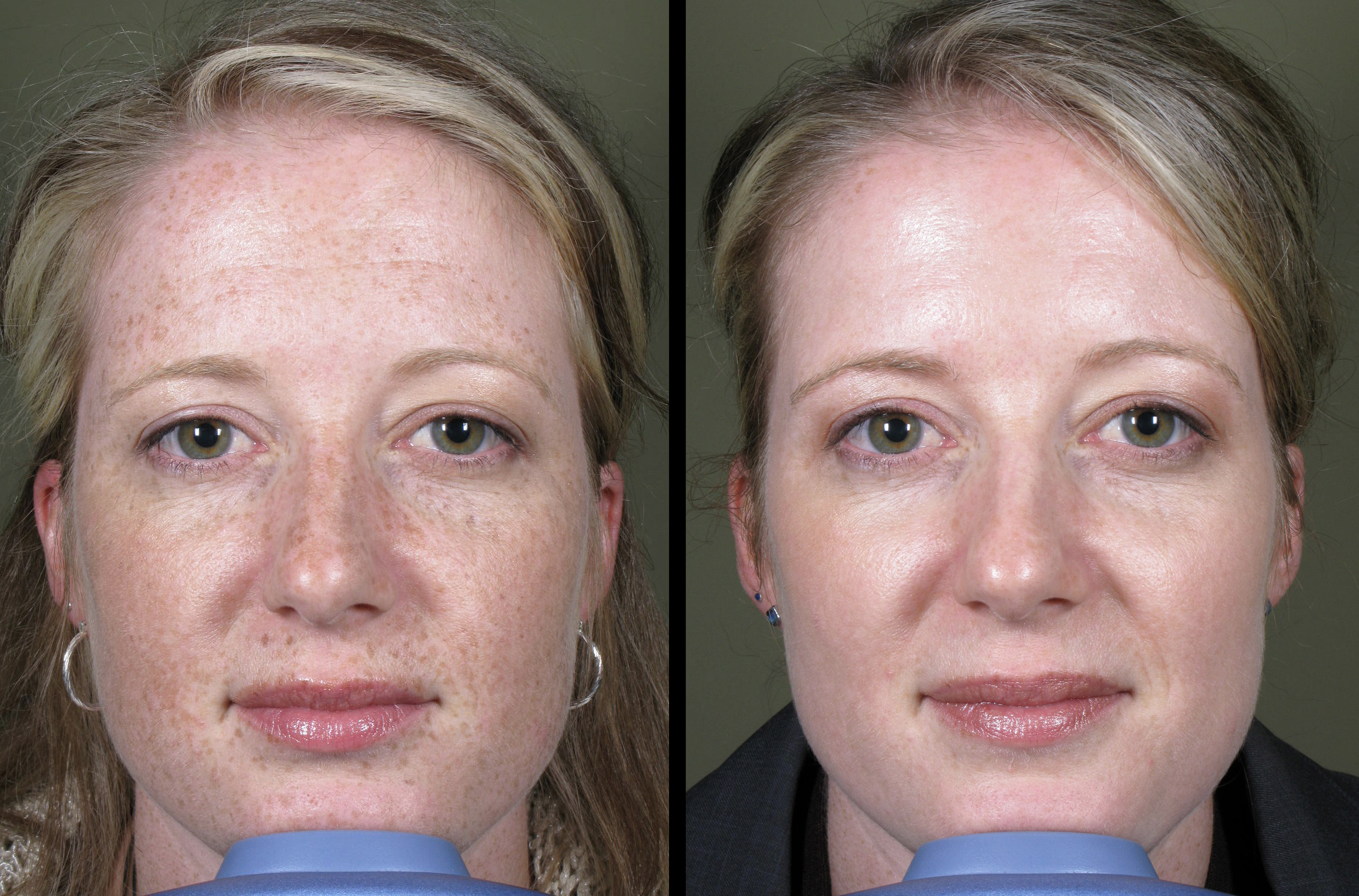 Laser Brown Spots 1 MD ESTHETICS