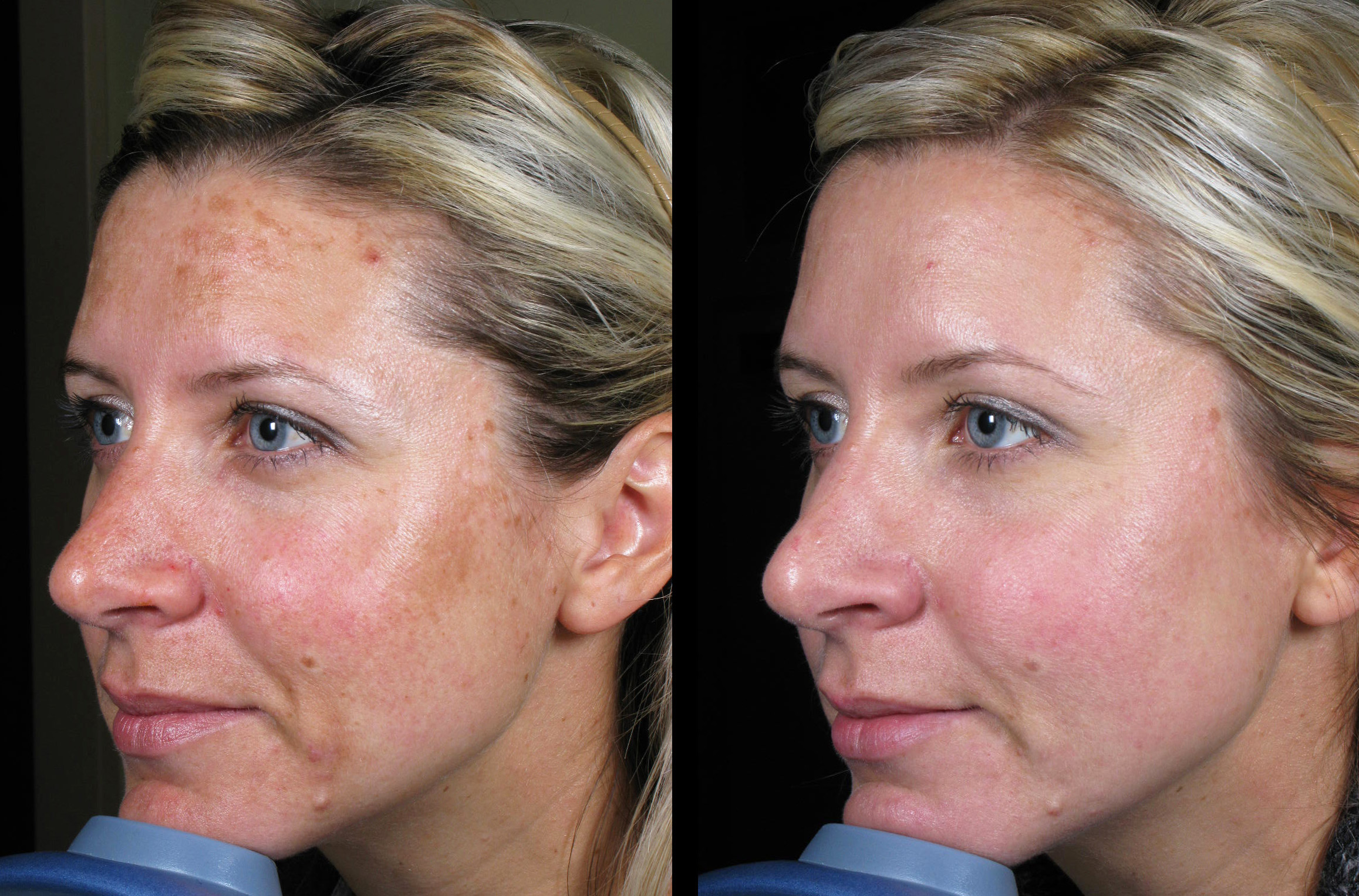 laser-brown-spots-10-md-esthetics