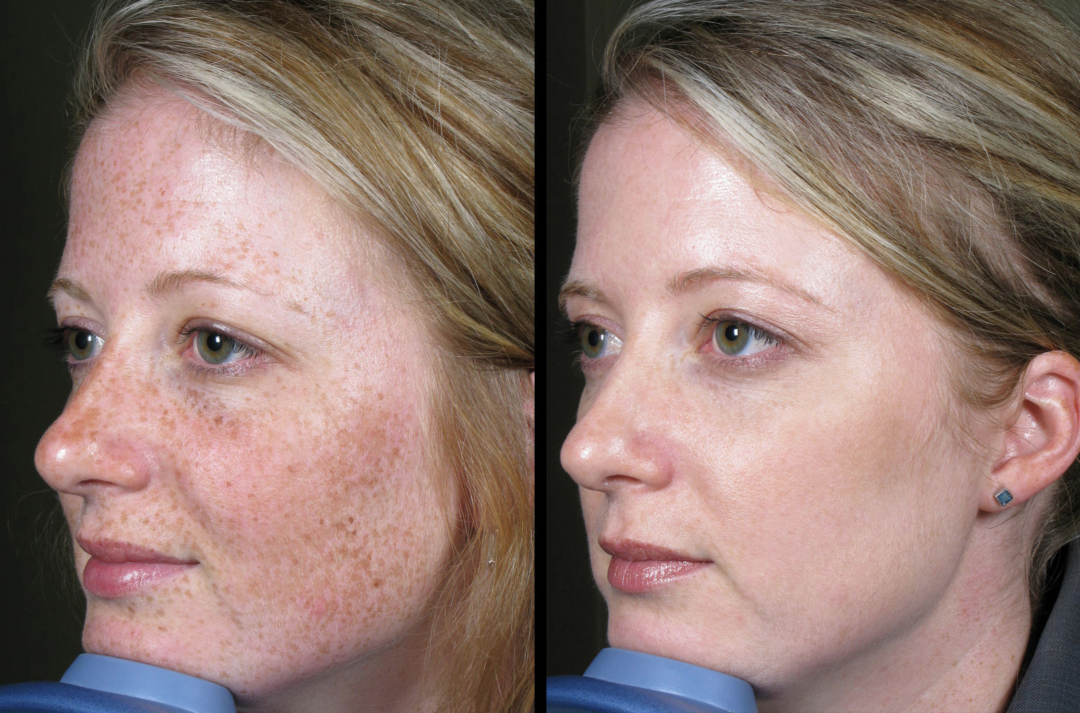 laser-brown-spots-2-md-esthetics