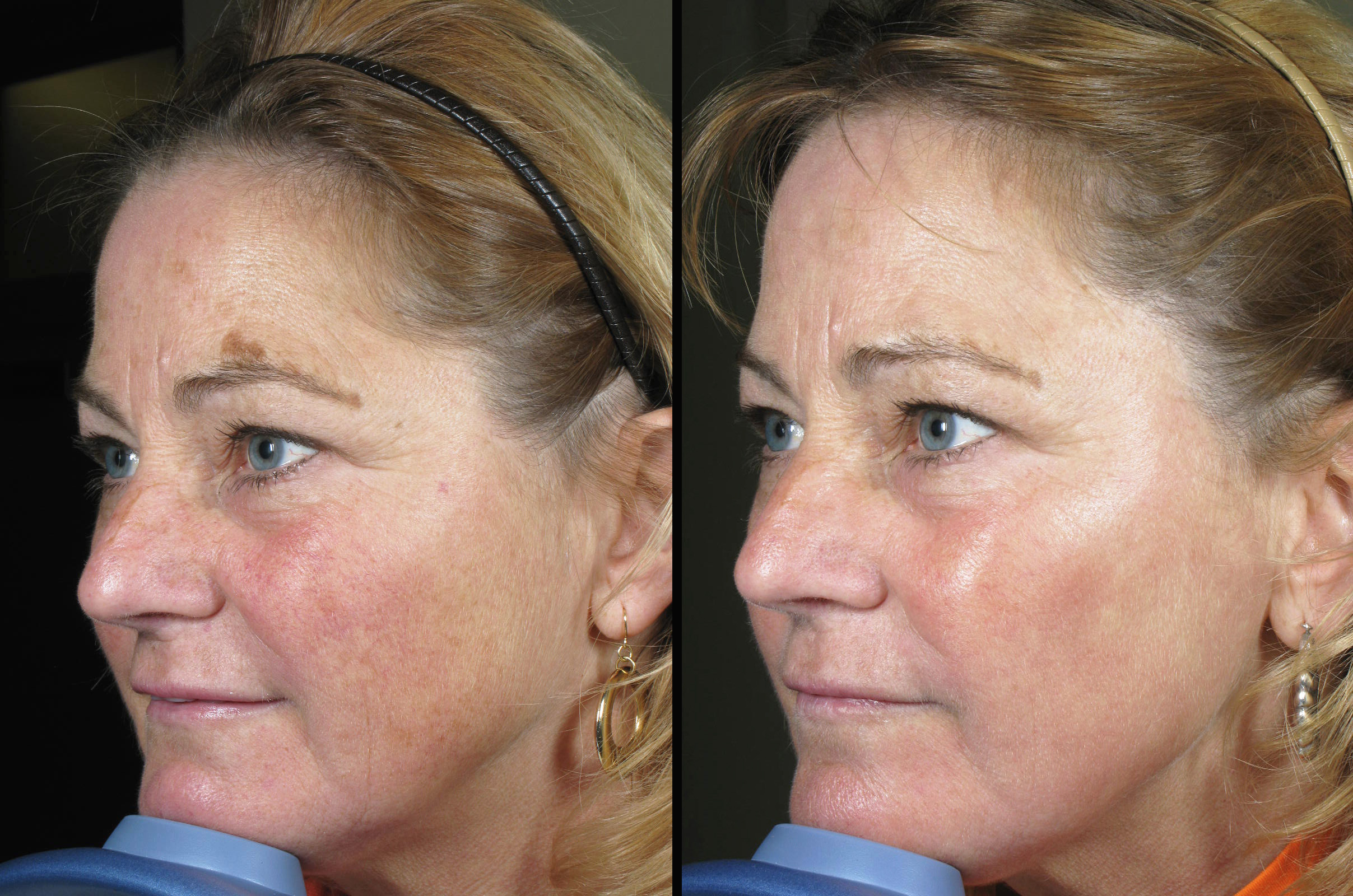 denver-laser-brown-spot-removal-raval-facial-aesthetics