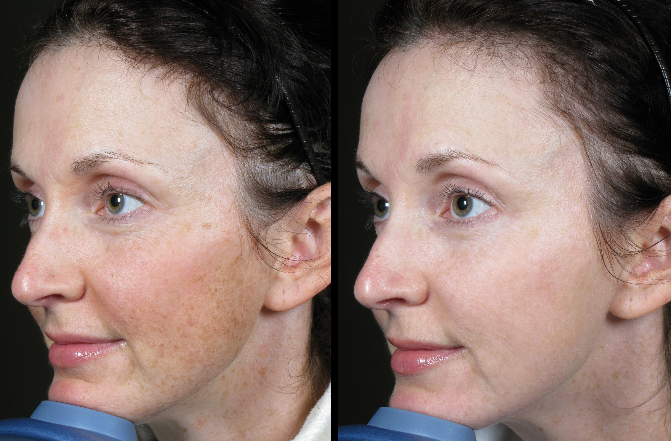 laser-brown-spots-5-md-esthetics