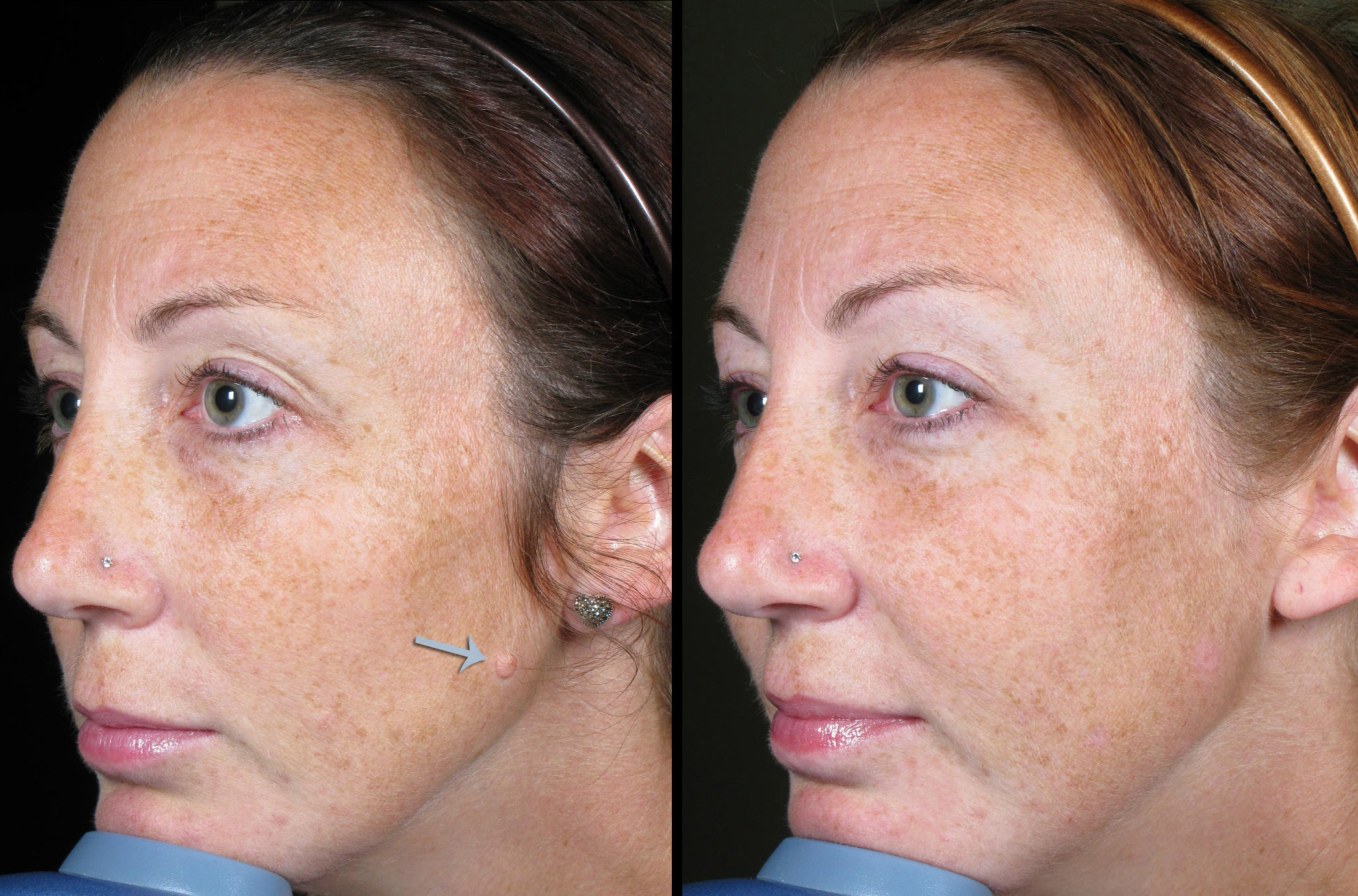 laser-mole-removal-2-md-esthetics