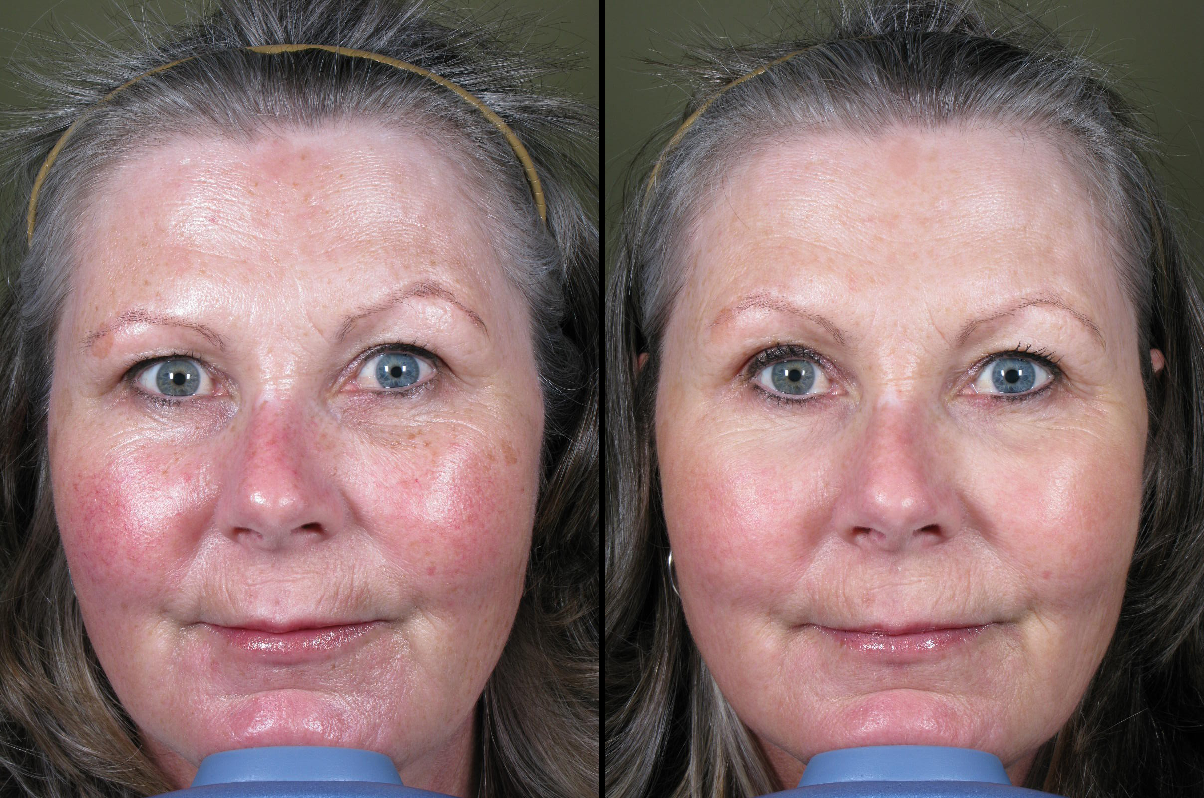 Laser for facial redness 2 MD ESTHETICS