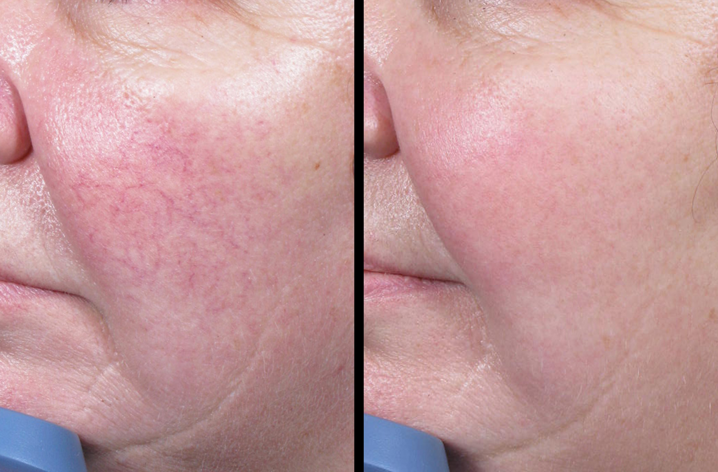 laser-for-facial-redness-5-md-esthetics