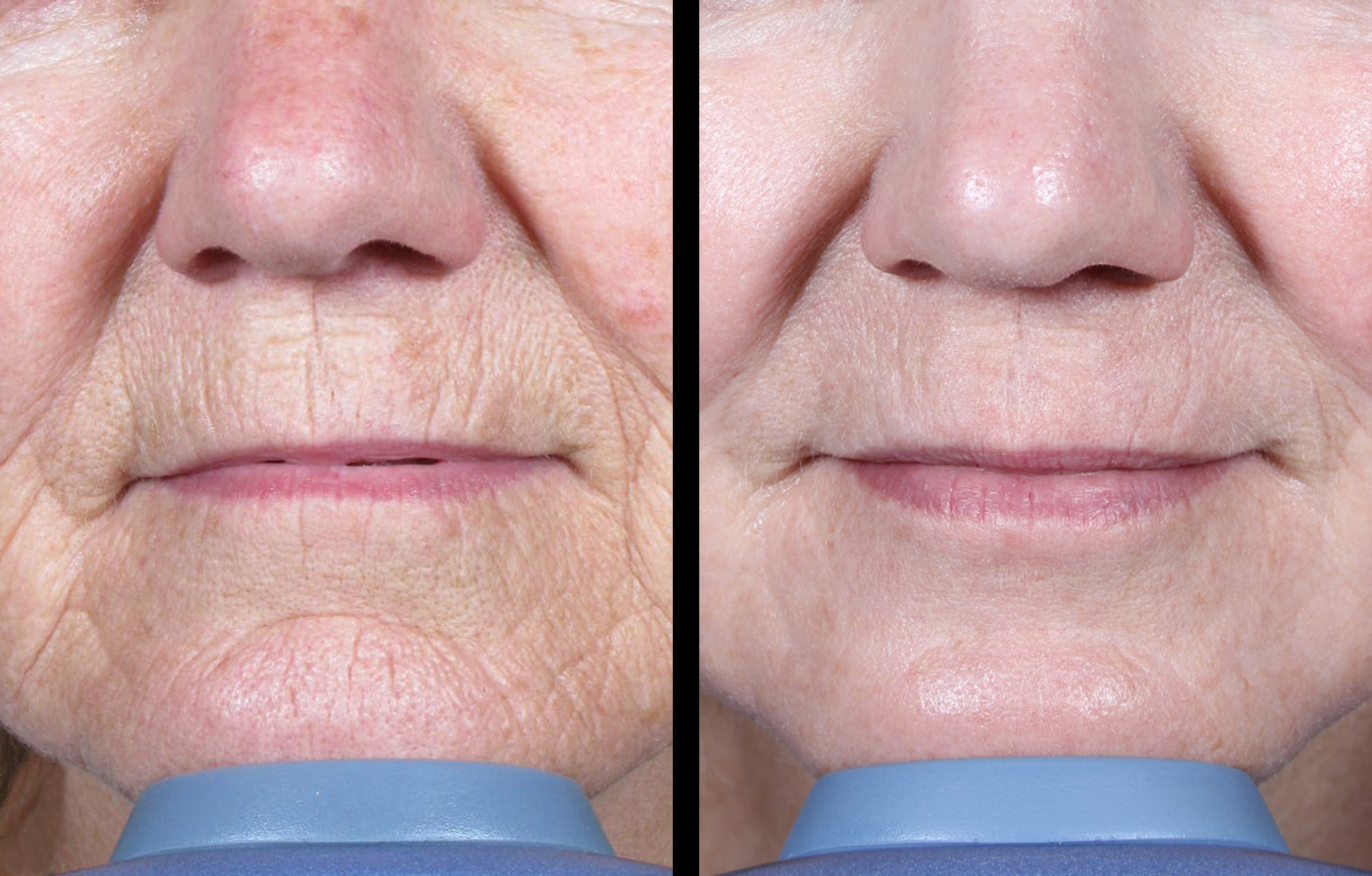 Mixto Laser Resurfacing 3 - MD ESTHETICS