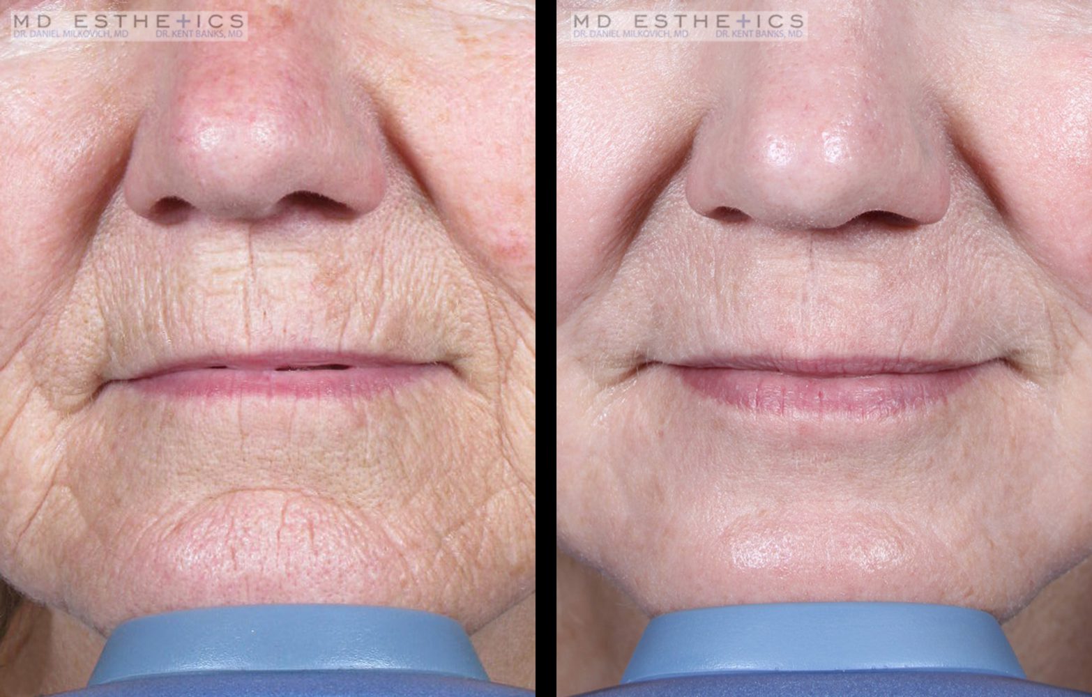 Let the Force of Lasers Transform Your Skin MD ESTHETICS