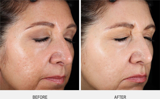 Venus Viva Before After Md Esthetics 3883