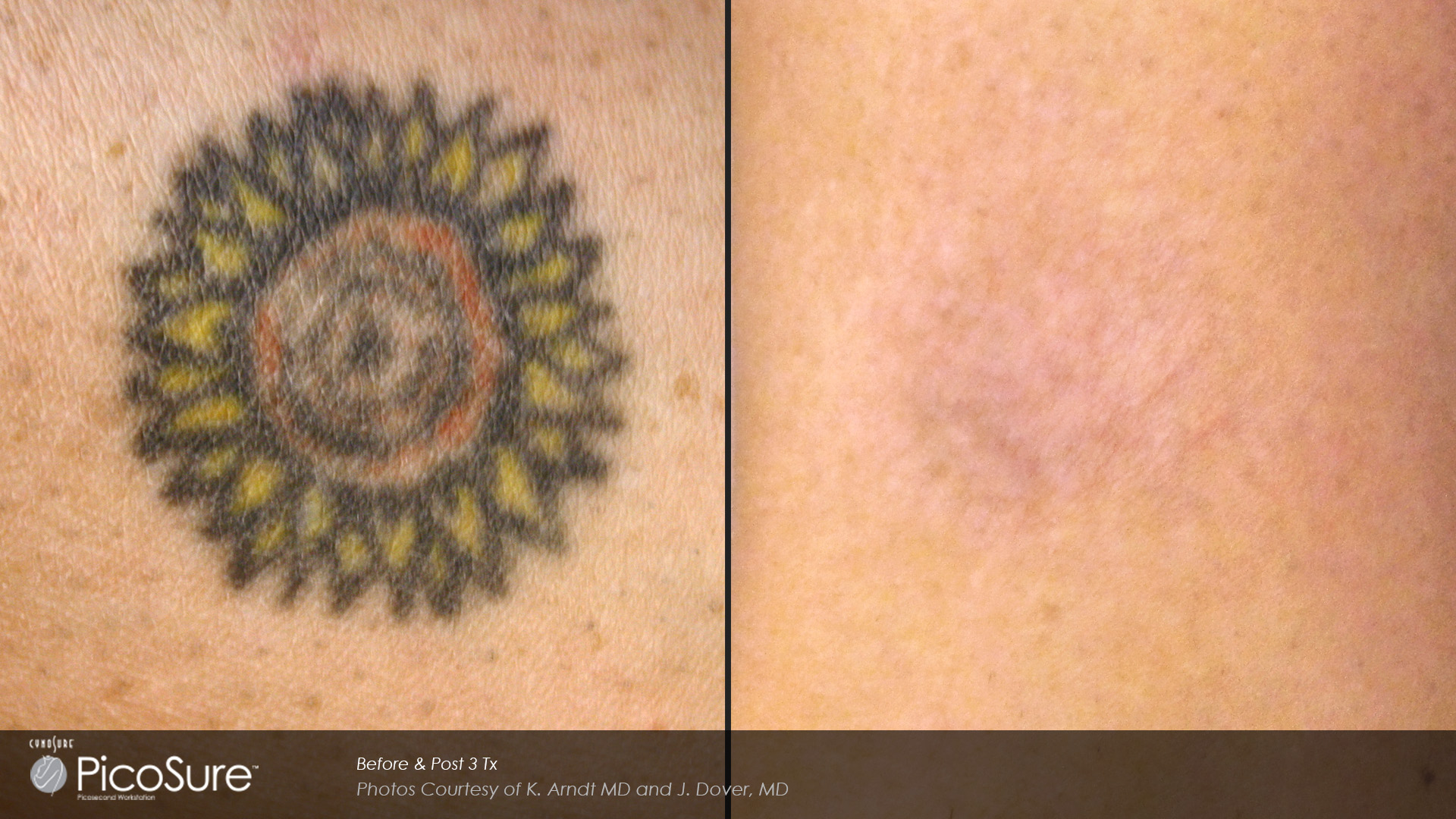 MD ESTHETICS Now Offers PicoSure® Tattoo Removal in Victoria BC - MD  ESTHETICS