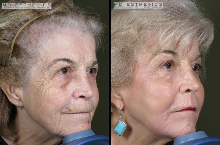 How Much Does Laser Skin Resurfacing Cost